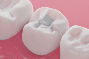 why-composite-fillings-are-the-top-choice-for-a-seamless-smile