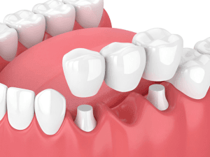 are-dental-bridges-painful-debunking-common-myths