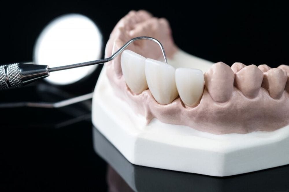 are-dental-crowns-an-effective-solution-for-cracked-or-worn-teeth