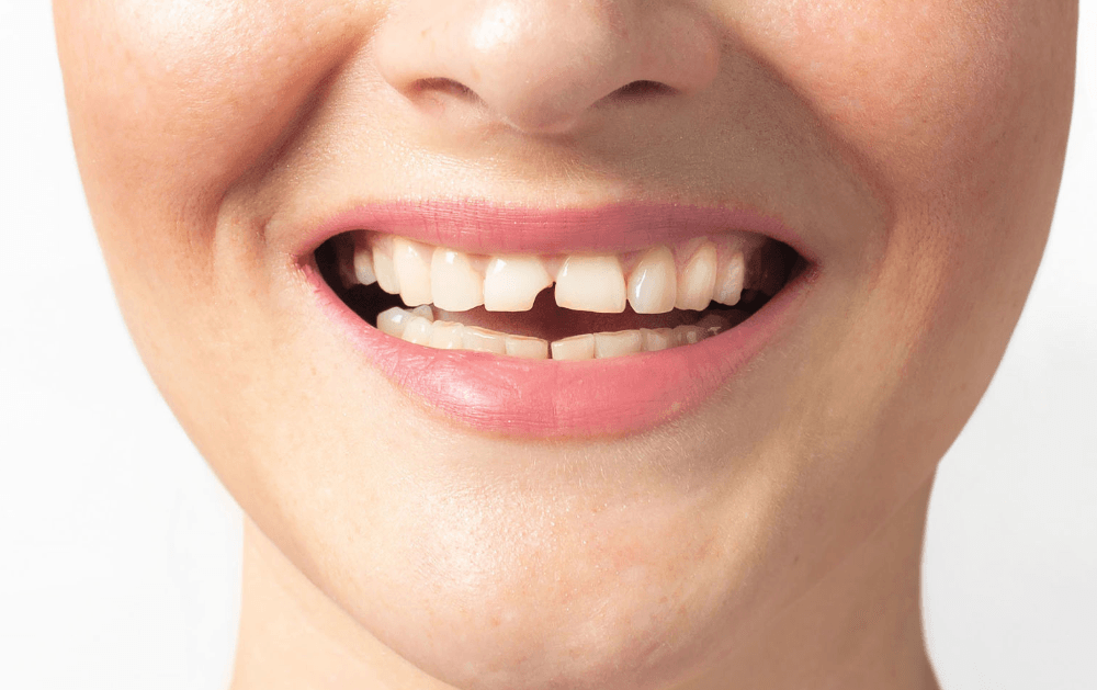 Can a Cracked Tooth Be Fixed? Exploring Your Options